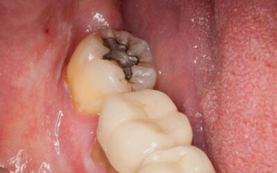 Una notizia molto interessante riguardante l’Amalgama Dentale