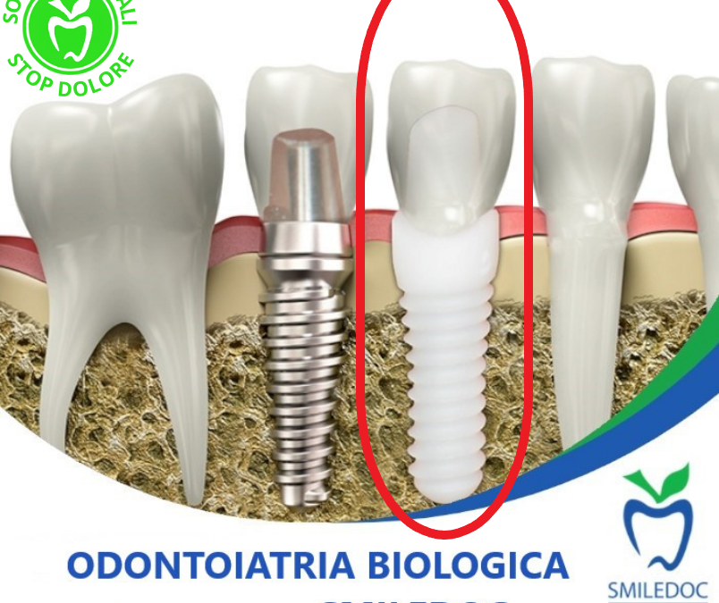 Differenze tra impianti in Zarconia e in Titanio