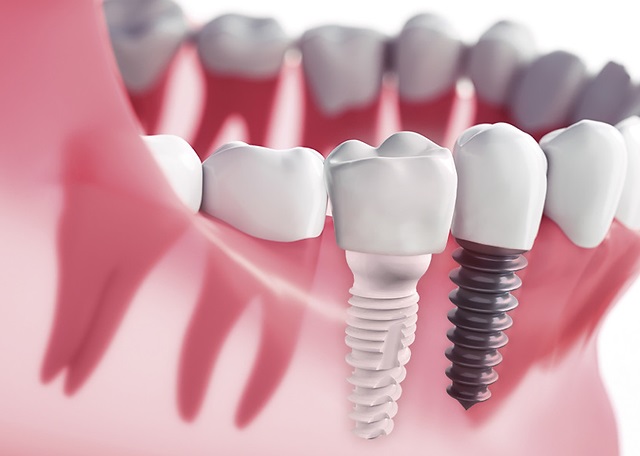 Ritorna a sorridere in sicurezza: gli impianti dentali in Zirconia