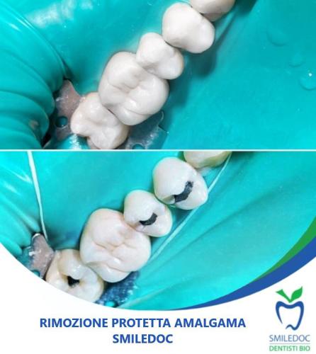 Rimozione Protetta Amalgama Dentale Monterotondo